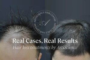 Hair Loss