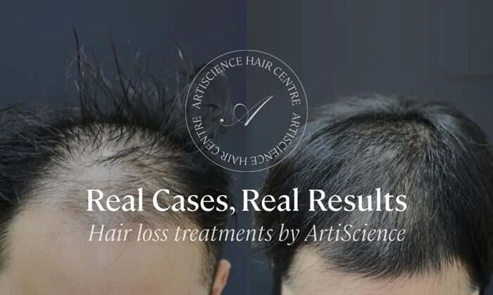 Hair Loss