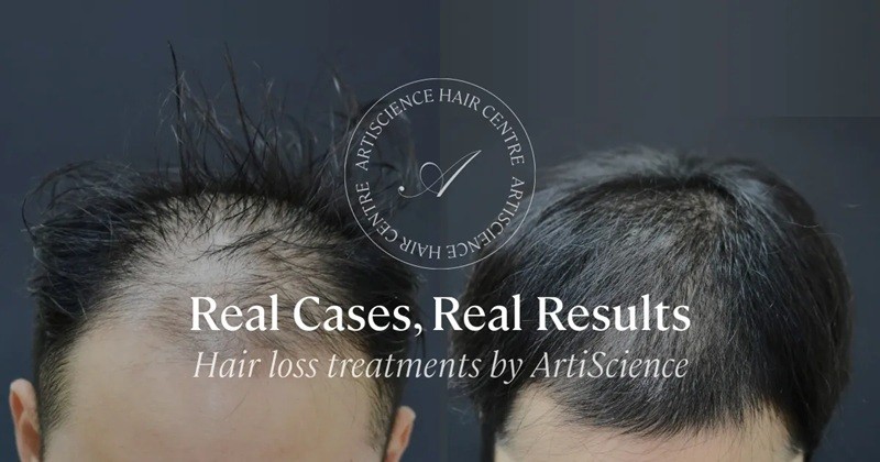 Hair Loss