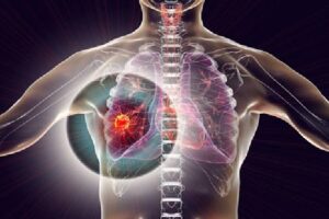 Lung Cancer