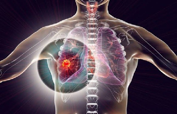 Lung Cancer