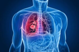 Pulmonary Function Tests