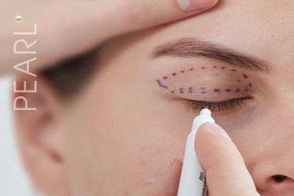 Eyelid Surgery Singapore